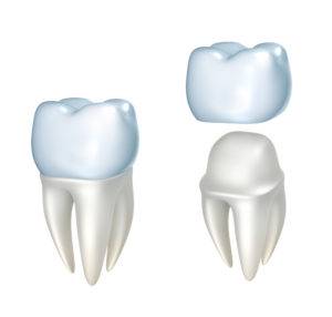 Dental Crowns West Oaks - Dr Micheal Tran - FLOSS Dental - West Oaks Houston