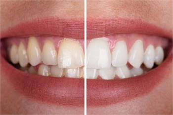 Get A Perfect Shiny White Smile With Teeth Whitening Treatment
