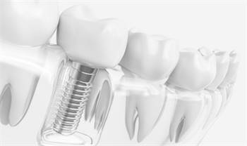 Implant Dentist Phoenix | Phoenix Dentist | Dentist Near Me | Dentist 85029